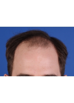 Before Hair Transplant&nbsp;Front